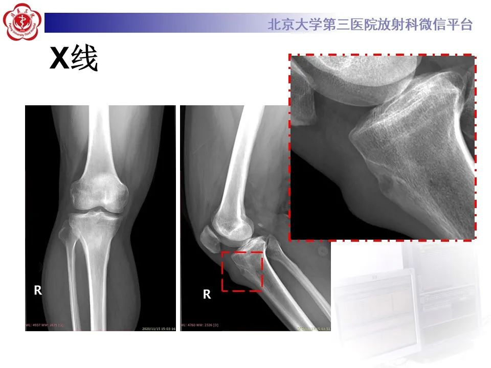 影像PPT - 【PPT】痛风性膝关节炎-4