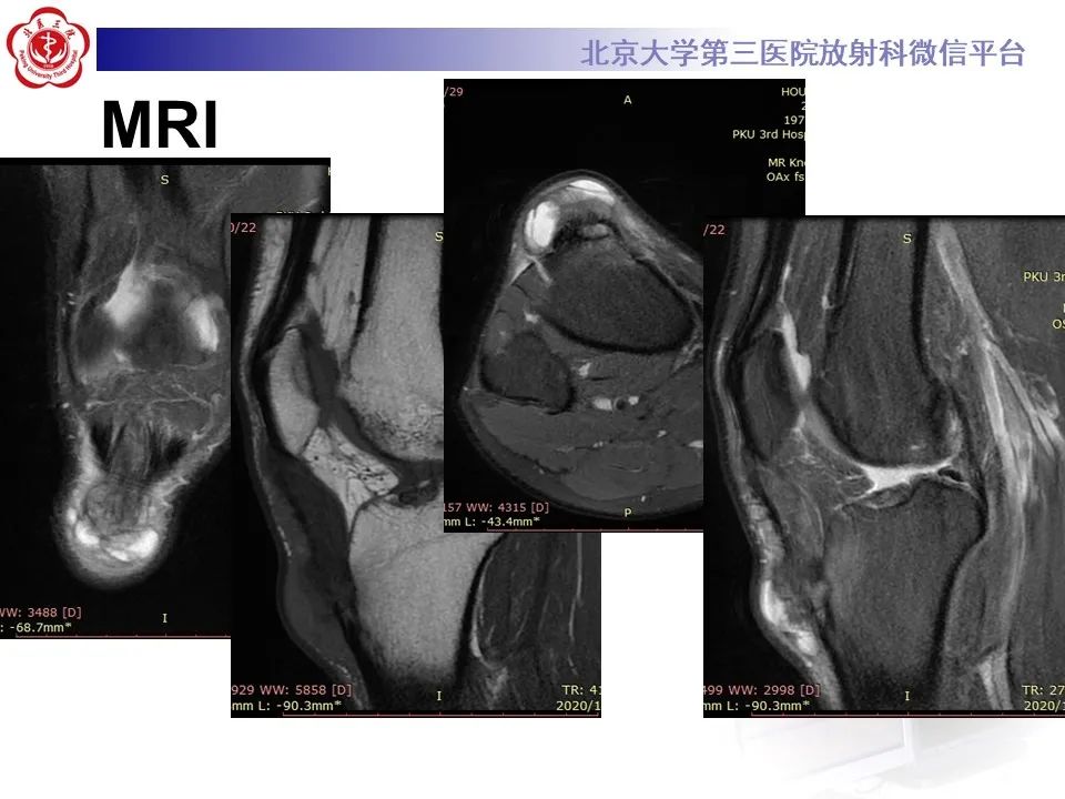 影像PPT - 【PPT】痛风性膝关节炎-6