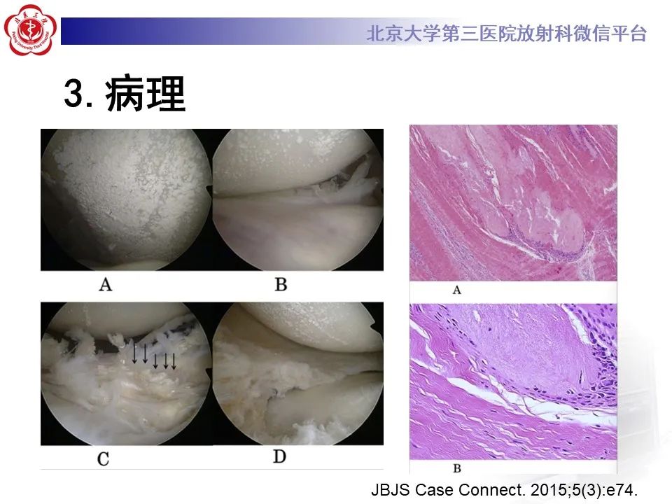 影像PPT - 【PPT】痛风性膝关节炎-16