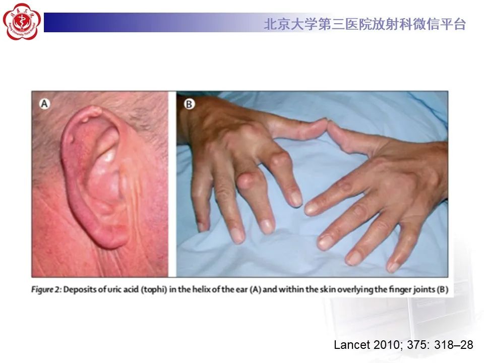 影像PPT - 【PPT】痛风性膝关节炎-15