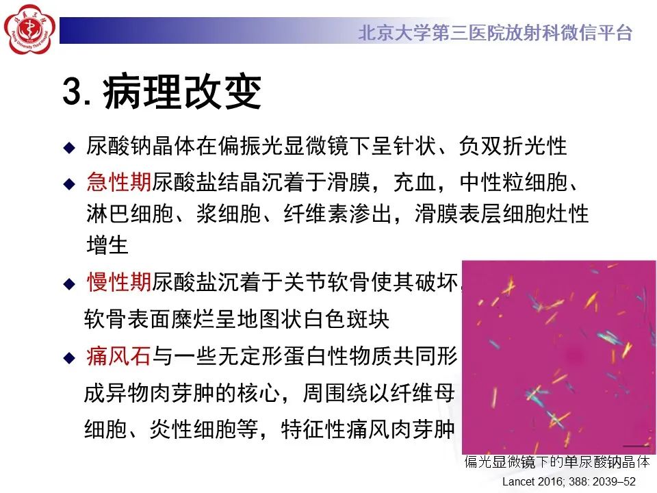 影像PPT - 【PPT】痛风性膝关节炎-14