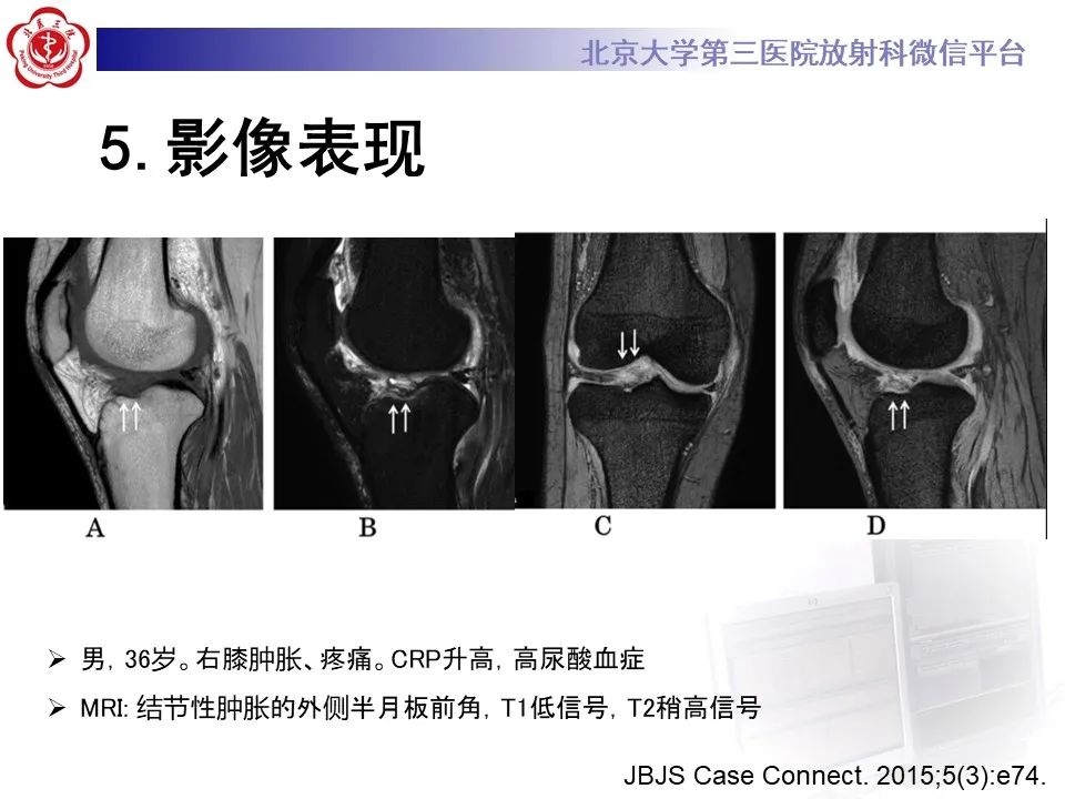 影像PPT - 【PPT】痛风性膝关节炎-21