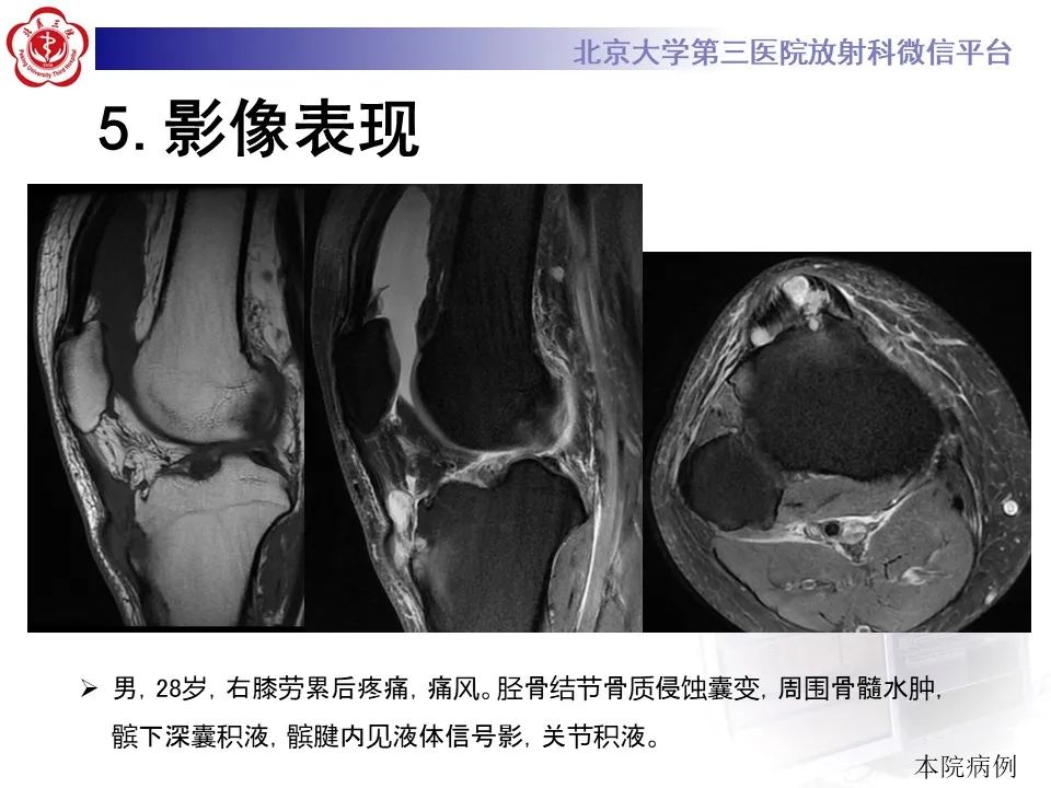 影像PPT - 【PPT】痛风性膝关节炎-20