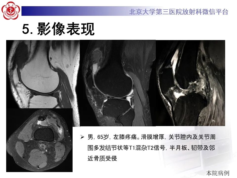 影像PPT - 【PPT】痛风性膝关节炎-23
