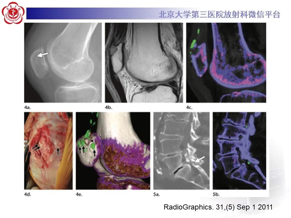 影像PPT - 【PPT】痛风性膝关节炎-22