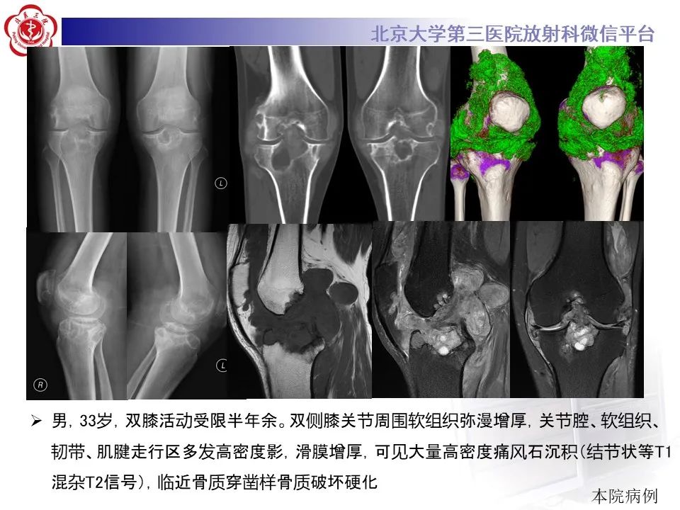 影像PPT - 【PPT】痛风性膝关节炎-24