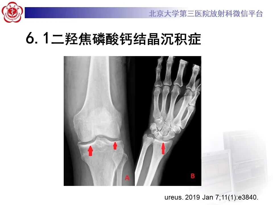 影像PPT - 【PPT】痛风性膝关节炎-27