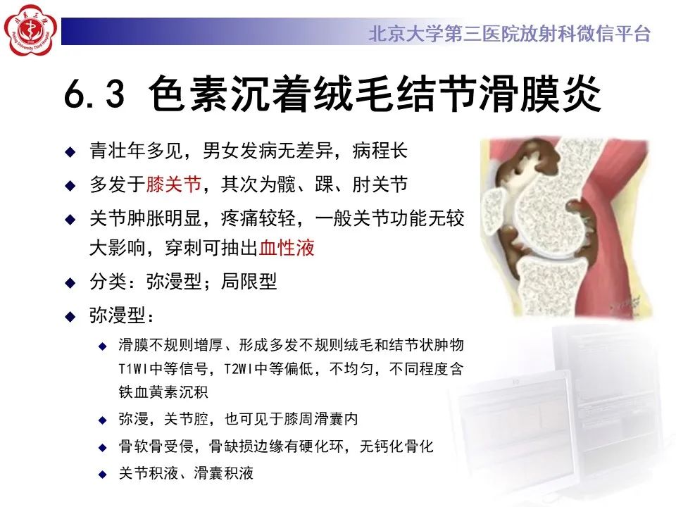 影像PPT - 【PPT】痛风性膝关节炎-30
