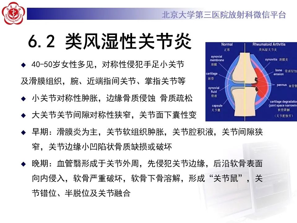 影像PPT - 【PPT】痛风性膝关节炎-28