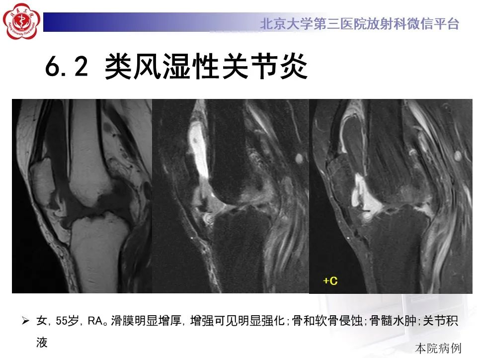 影像PPT - 【PPT】痛风性膝关节炎-29