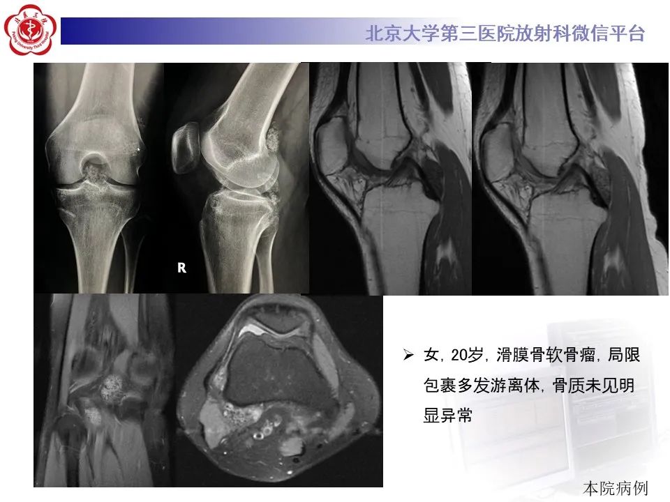 影像PPT - 【PPT】痛风性膝关节炎-34