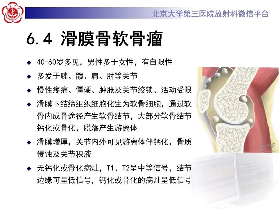 影像PPT - 【PPT】痛风性膝关节炎-33
