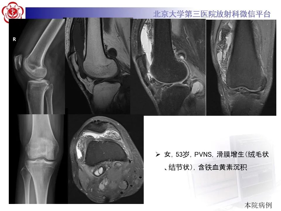 影像PPT - 【PPT】痛风性膝关节炎-32