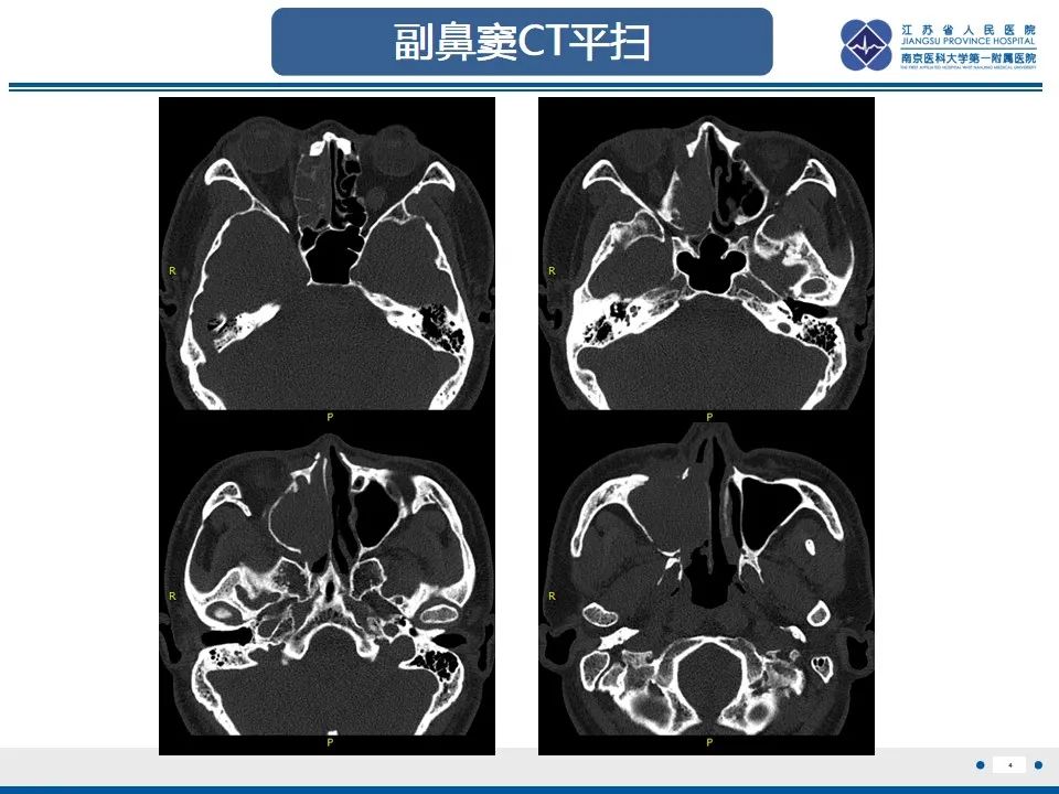 影像PPT - 【PPT】鼻腔鼻窦鳞状细胞癌-5