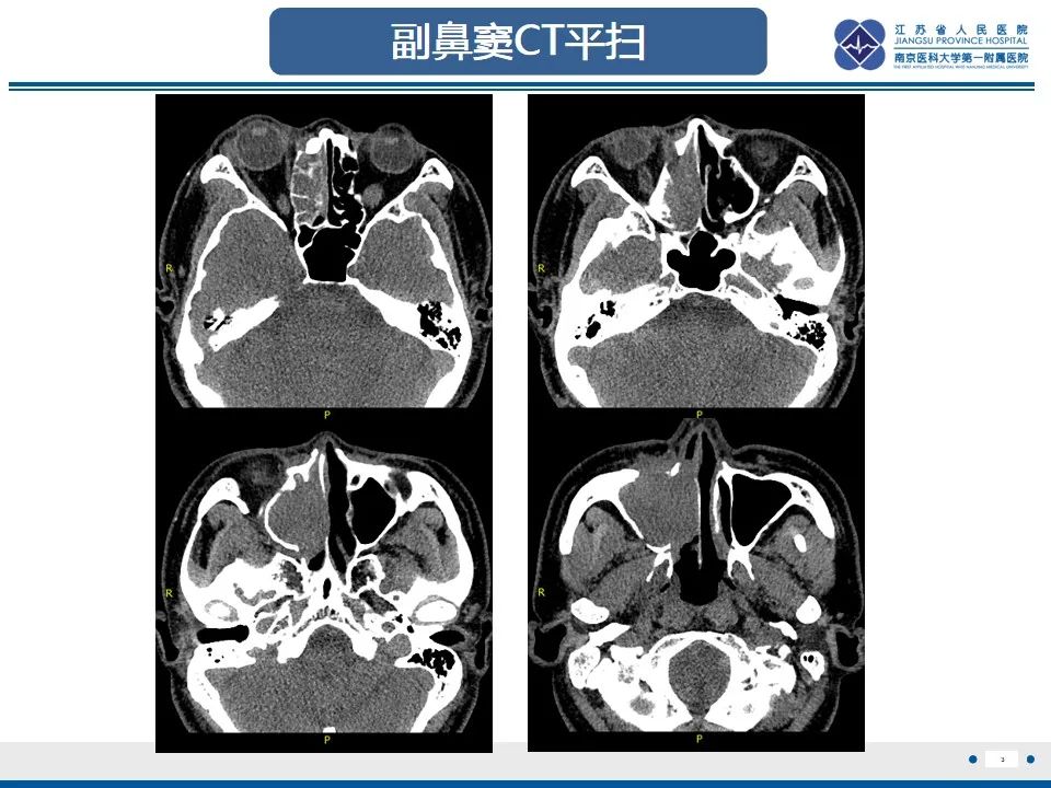 影像PPT - 【PPT】鼻腔鼻窦鳞状细胞癌-4