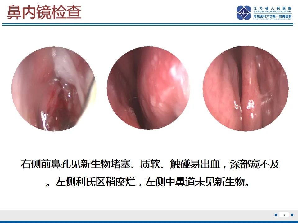 影像PPT - 【PPT】鼻腔鼻窦鳞状细胞癌-3