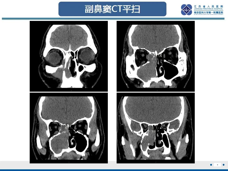 影像PPT - 【PPT】鼻腔鼻窦鳞状细胞癌-6