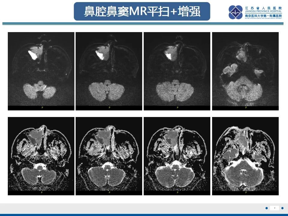 影像PPT - 【PPT】鼻腔鼻窦鳞状细胞癌-8