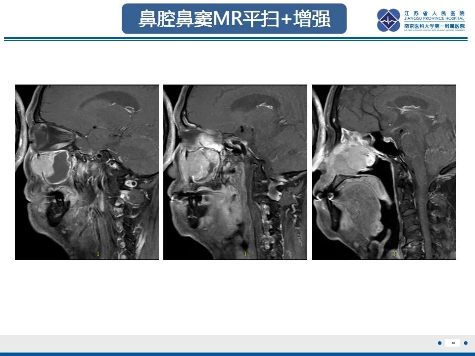影像PPT - 【PPT】鼻腔鼻窦鳞状细胞癌-11