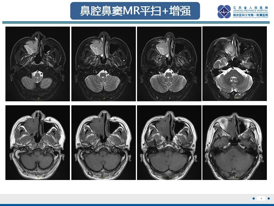影像PPT - 【PPT】鼻腔鼻窦鳞状细胞癌-7