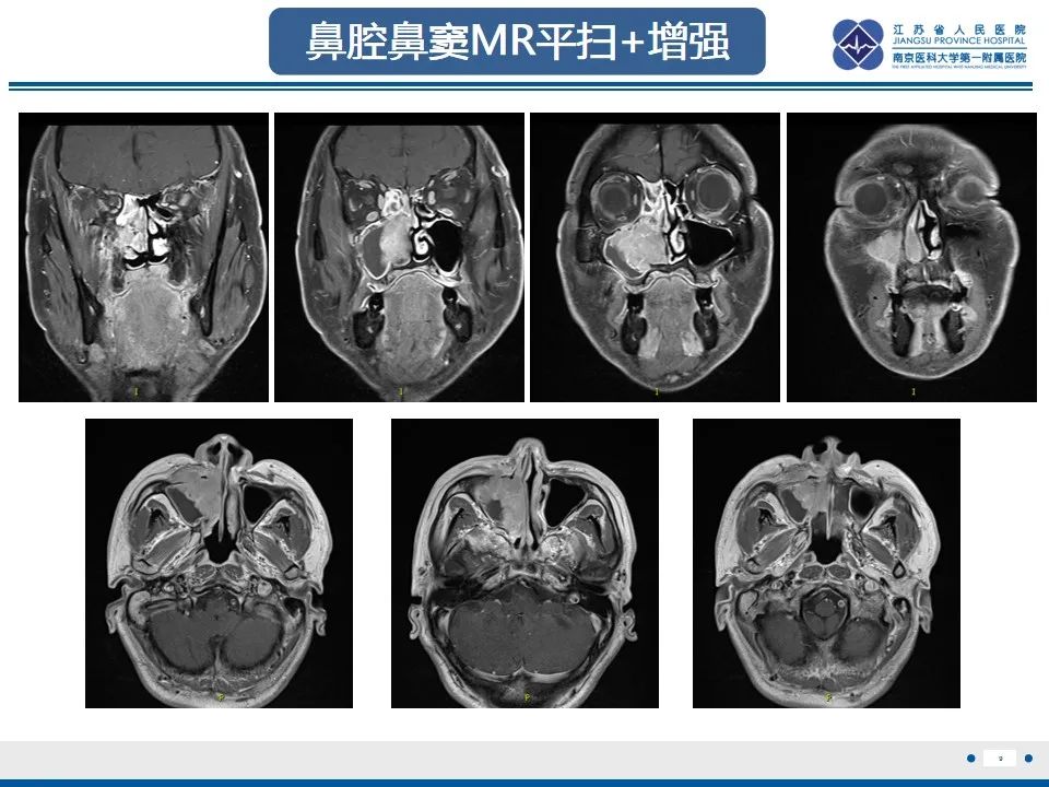 影像PPT - 【PPT】鼻腔鼻窦鳞状细胞癌-10