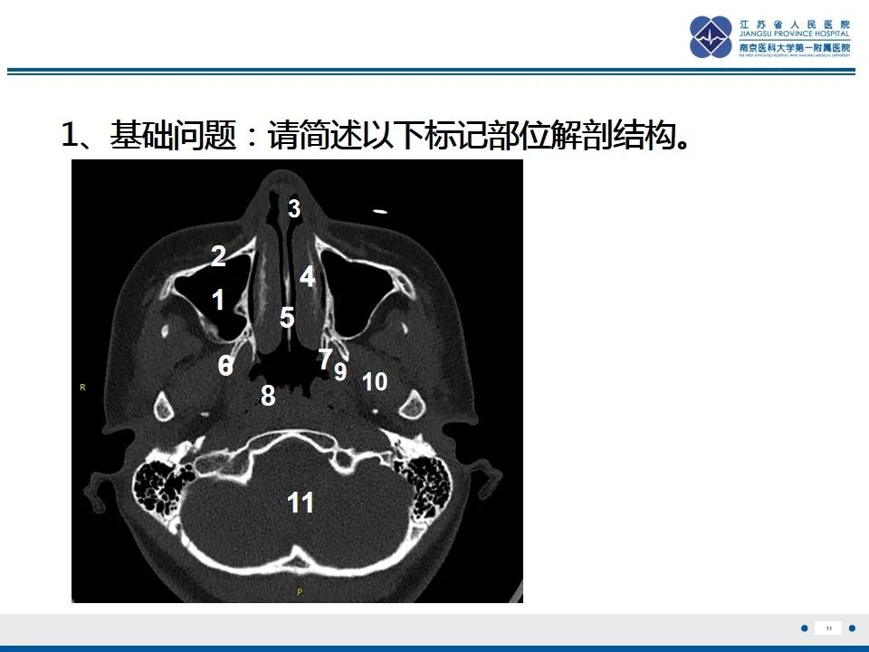 影像PPT - 【PPT】鼻腔鼻窦鳞状细胞癌-12