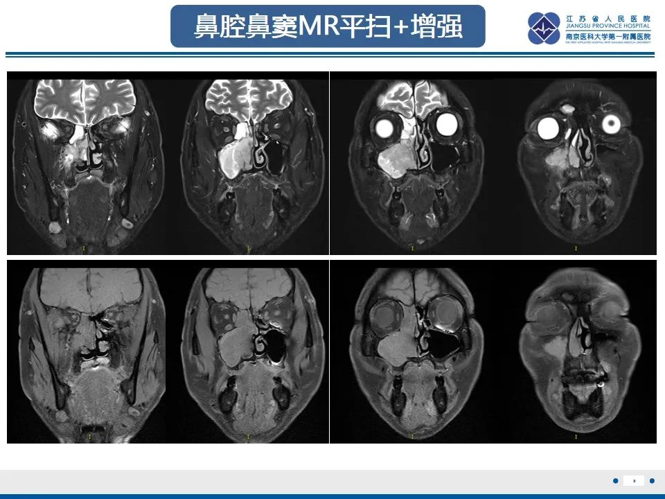 影像PPT - 【PPT】鼻腔鼻窦鳞状细胞癌-9