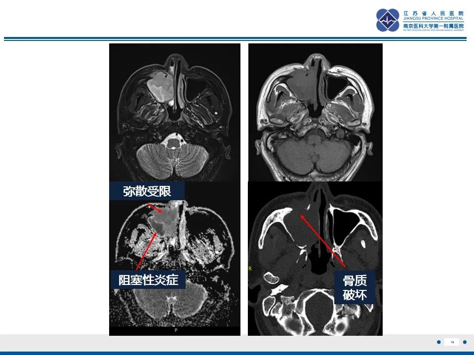 影像PPT - 【PPT】鼻腔鼻窦鳞状细胞癌-19