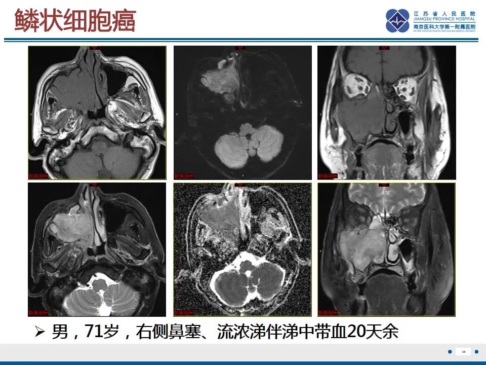 影像PPT - 【PPT】鼻腔鼻窦鳞状细胞癌-35