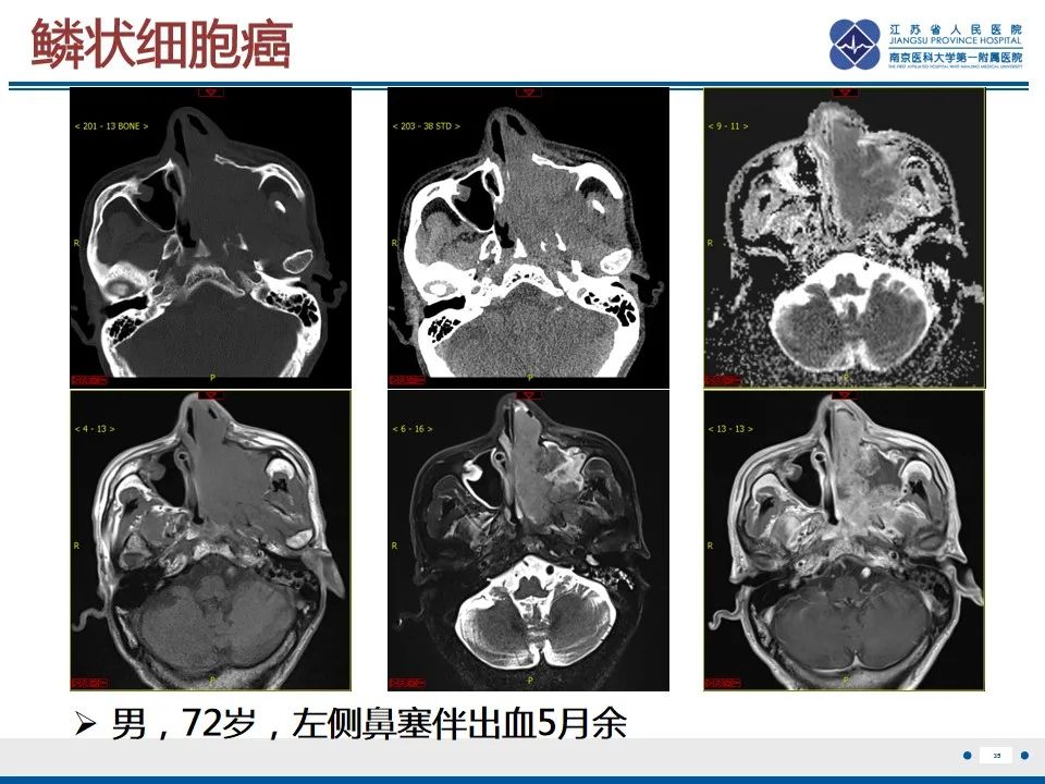 影像PPT - 【PPT】鼻腔鼻窦鳞状细胞癌-36