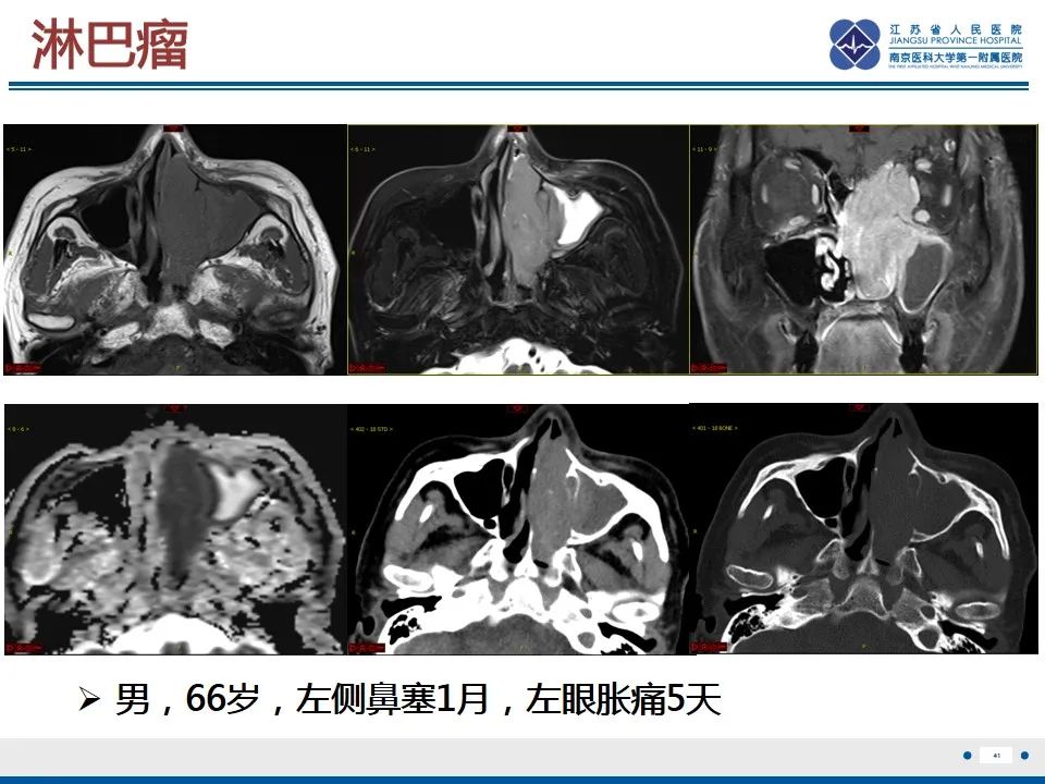 影像PPT - 【PPT】鼻腔鼻窦鳞状细胞癌-42