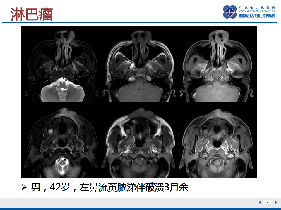 影像PPT - 【PPT】鼻腔鼻窦鳞状细胞癌-41