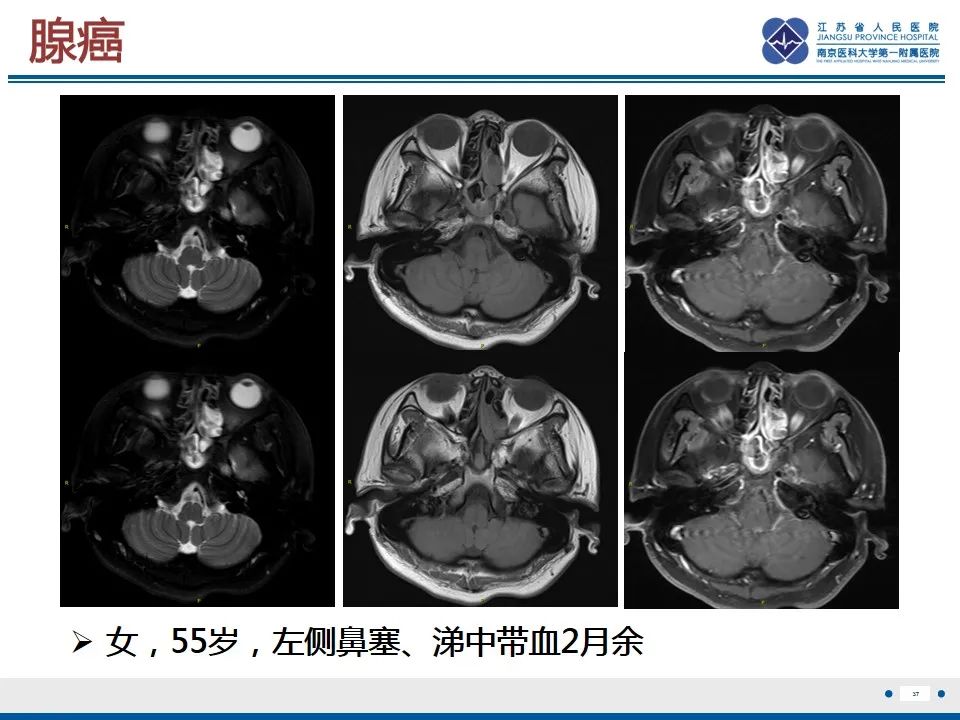 影像PPT - 【PPT】鼻腔鼻窦鳞状细胞癌-38