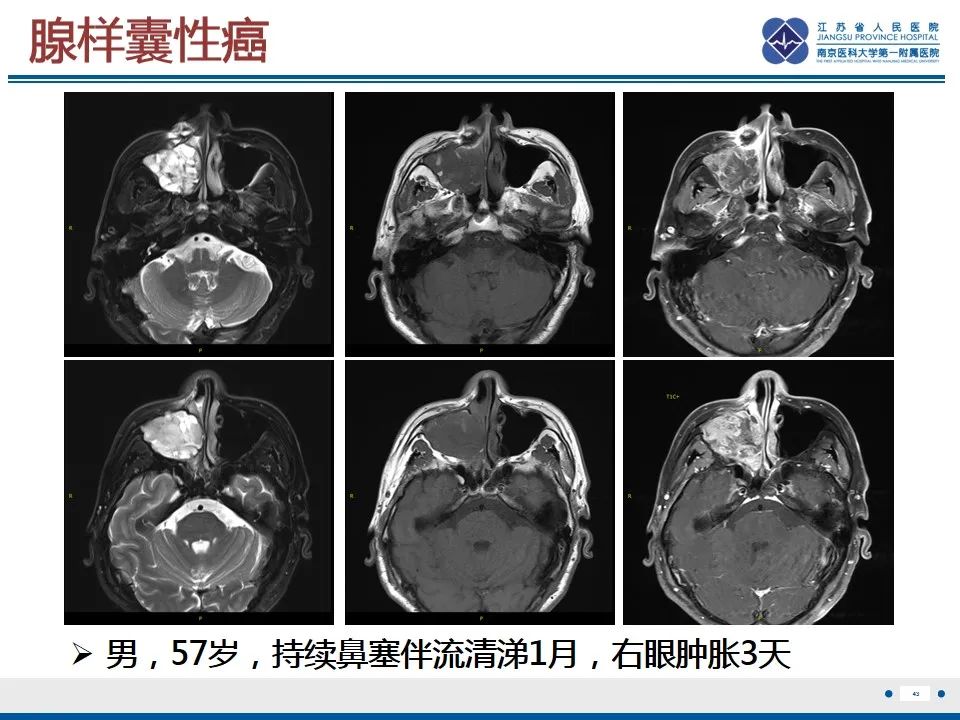 影像PPT - 【PPT】鼻腔鼻窦鳞状细胞癌-44