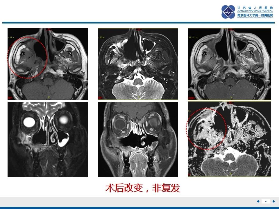 影像PPT - 【PPT】鼻腔鼻窦鳞状细胞癌-46