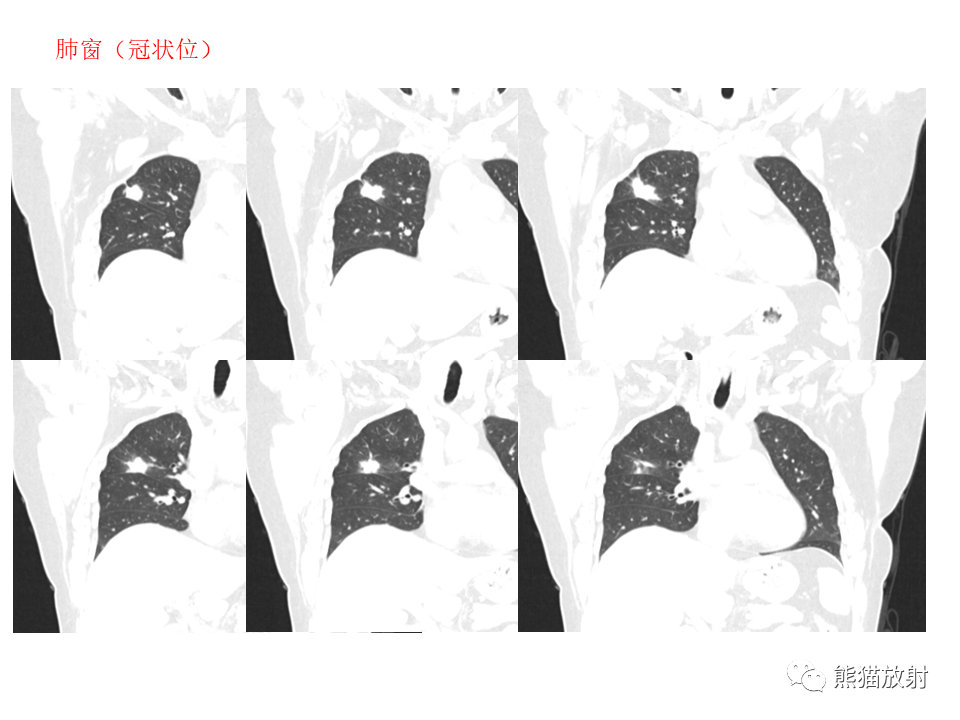 影像PPT - 【病例】肺隐球菌病2例CT影像-7