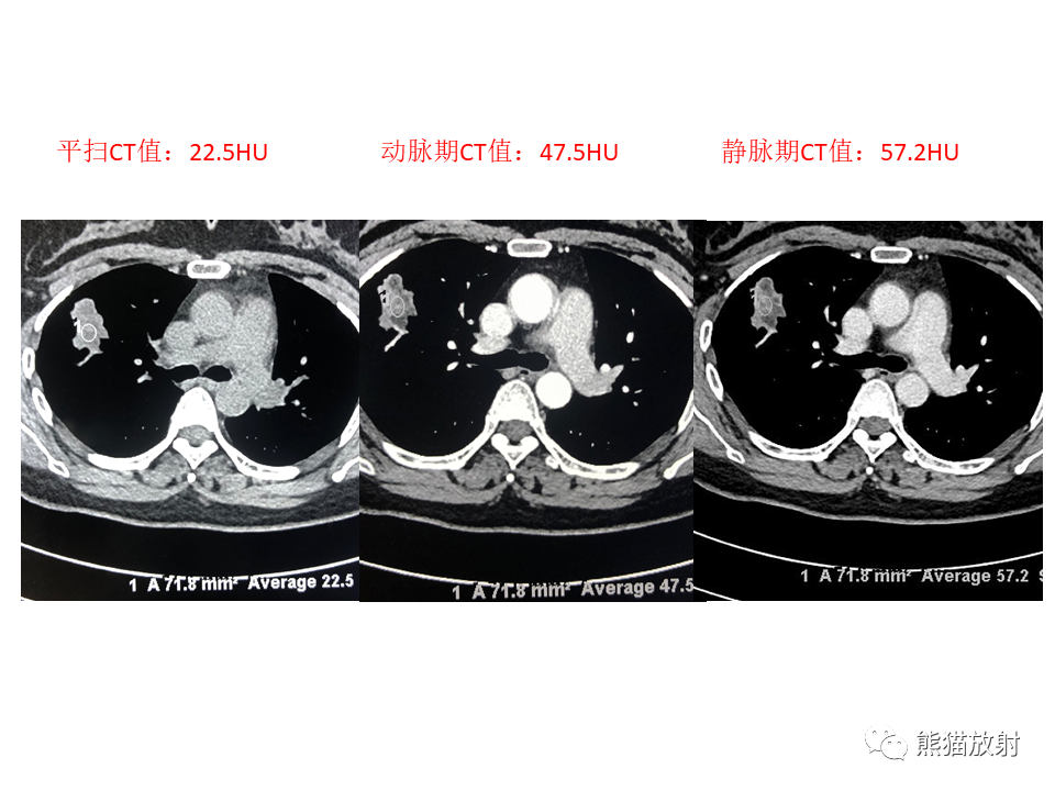 影像PPT - 【病例】肺隐球菌病2例CT影像-12