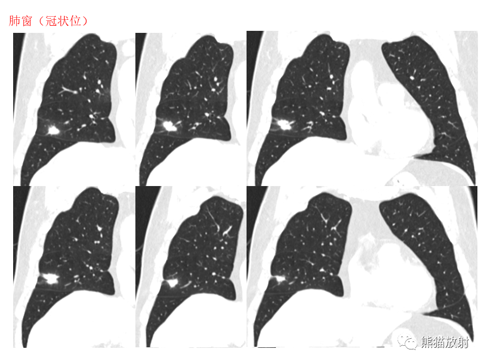 影像PPT - 【病例】肺隐球菌病2例CT影像-17