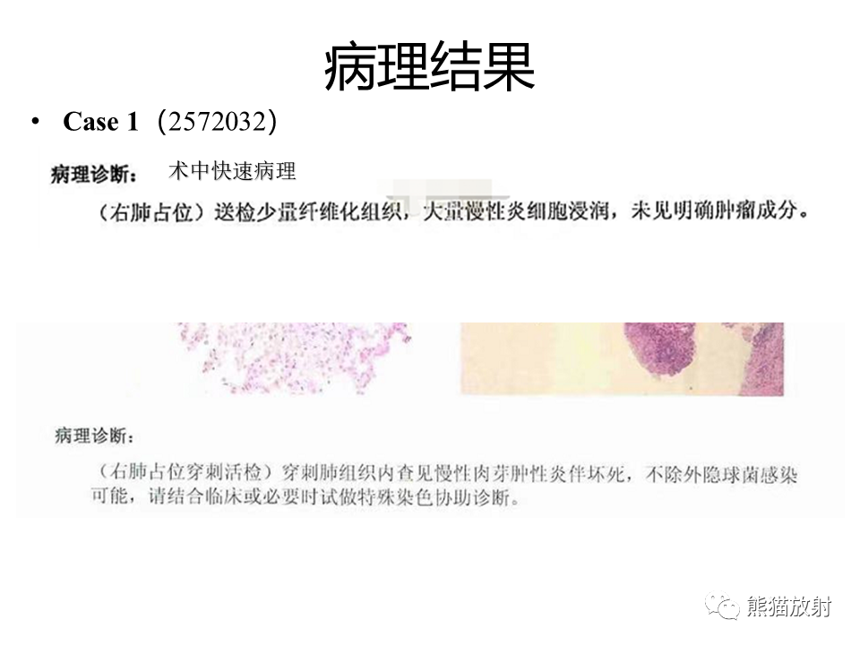 影像PPT - 【病例】肺隐球菌病2例CT影像-24