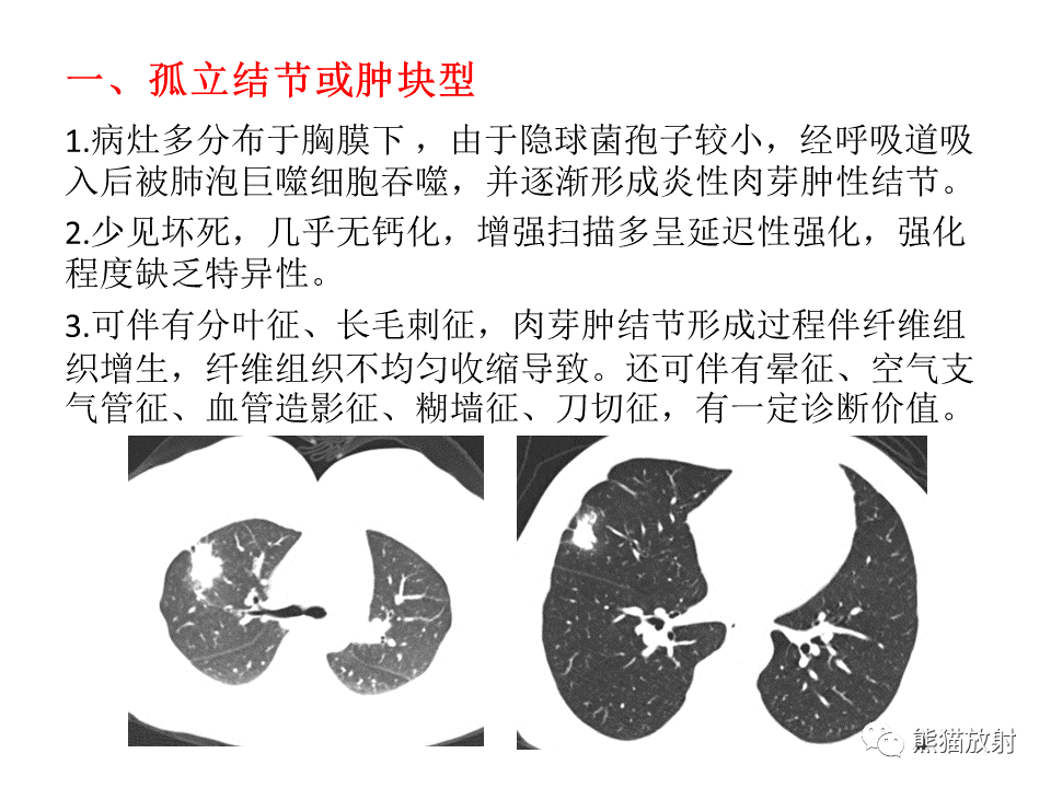 影像PPT - 【病例】肺隐球菌病2例CT影像-29