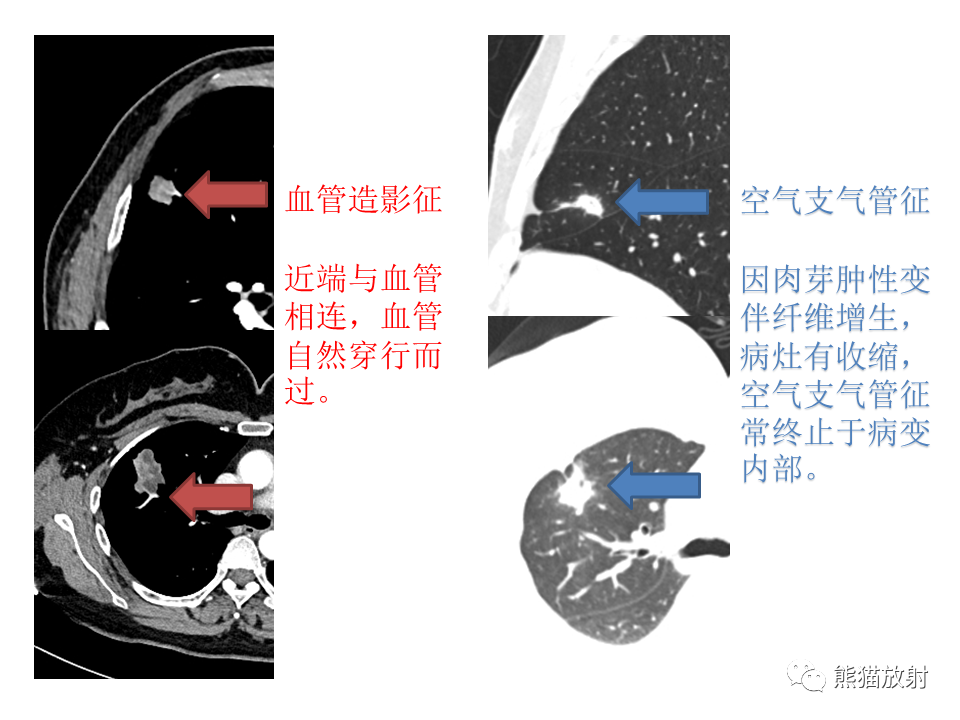 影像PPT - 【病例】肺隐球菌病2例CT影像-30