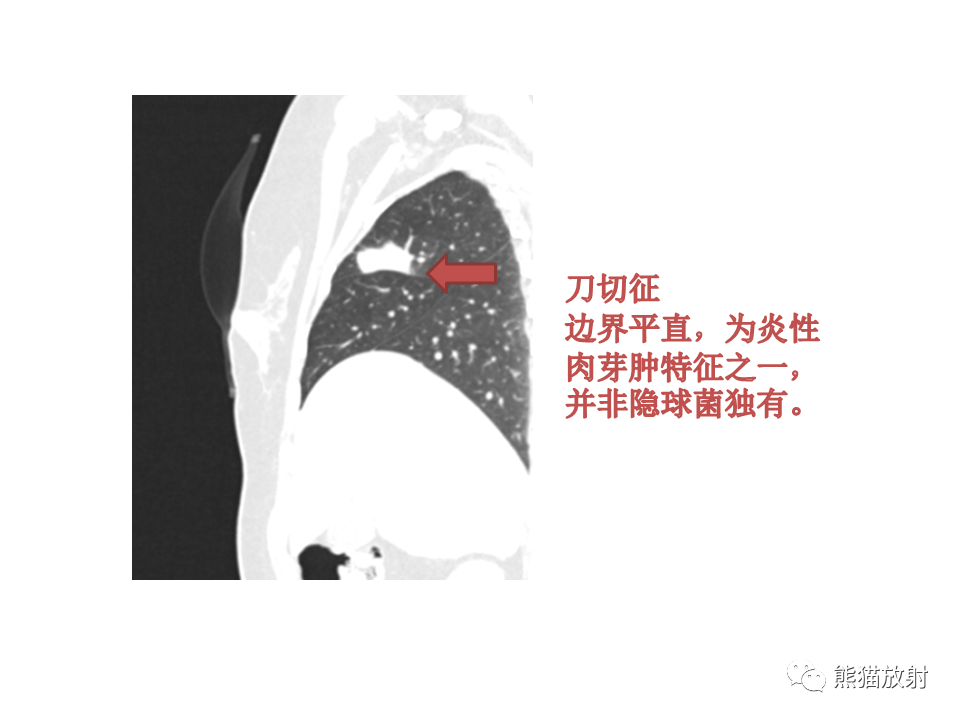 影像PPT - 【病例】肺隐球菌病2例CT影像-31