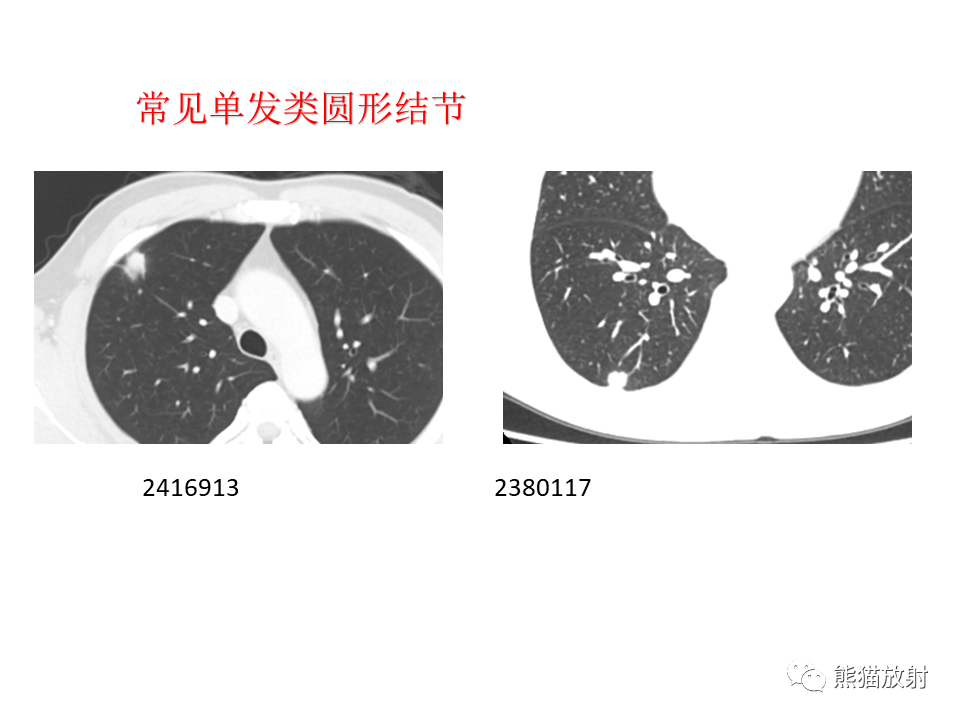 影像PPT - 【病例】肺隐球菌病2例CT影像-33