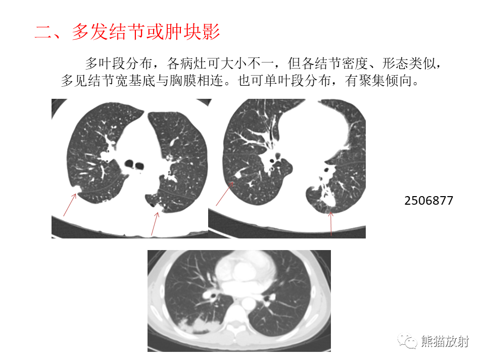 影像PPT - 【病例】肺隐球菌病2例CT影像-34
