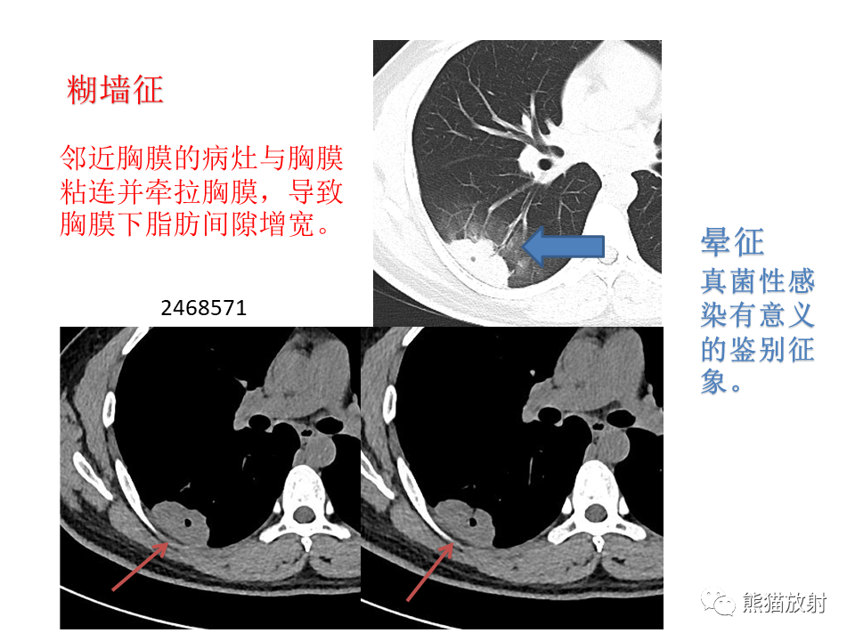 影像PPT - 【病例】肺隐球菌病2例CT影像-32