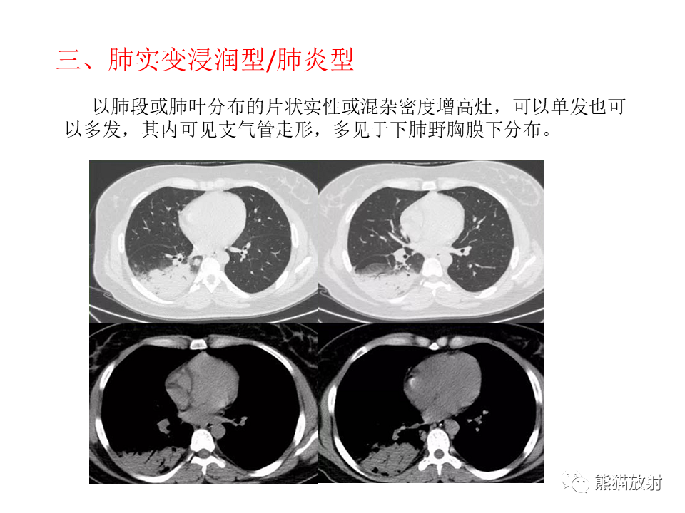 影像PPT - 【病例】肺隐球菌病2例CT影像-35