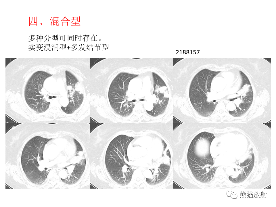 影像PPT - 【病例】肺隐球菌病2例CT影像-36