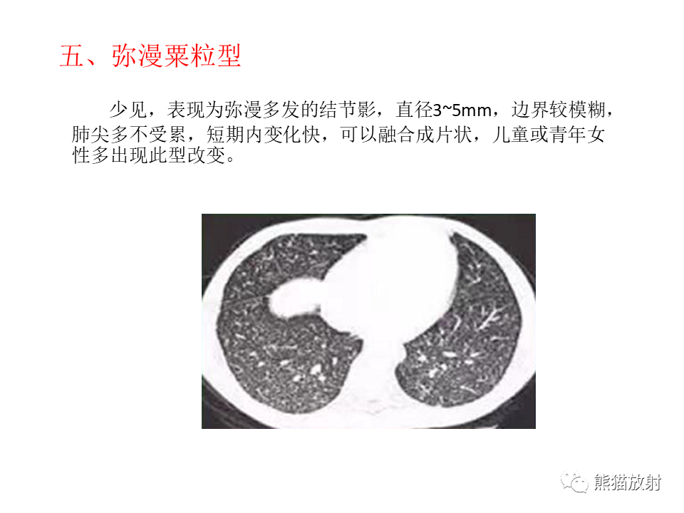 影像PPT - 【病例】肺隐球菌病2例CT影像-37