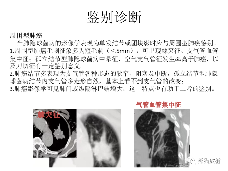 影像PPT - 【病例】肺隐球菌病2例CT影像-38