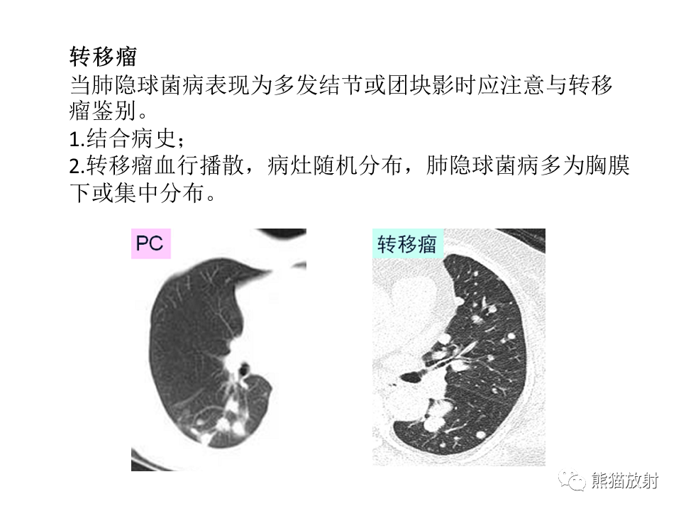 影像PPT - 【病例】肺隐球菌病2例CT影像-39